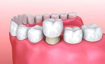 Dental crowns in Charlotte NC