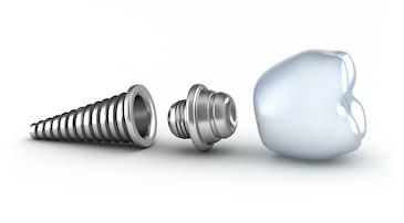 Dental implant layed out, charlotte nc