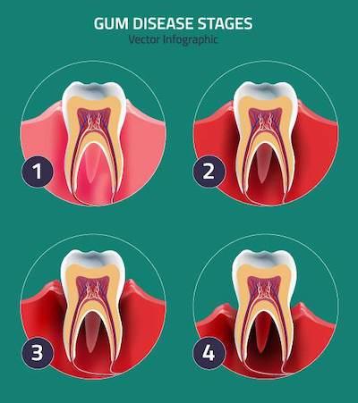 Gum disease stages infographic