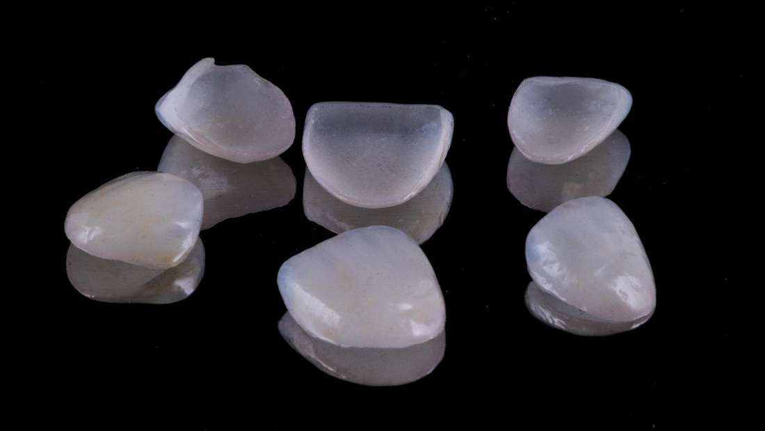 Can Dental Veneers Damage Healthy Teeth? Dental Veneers Charlotte