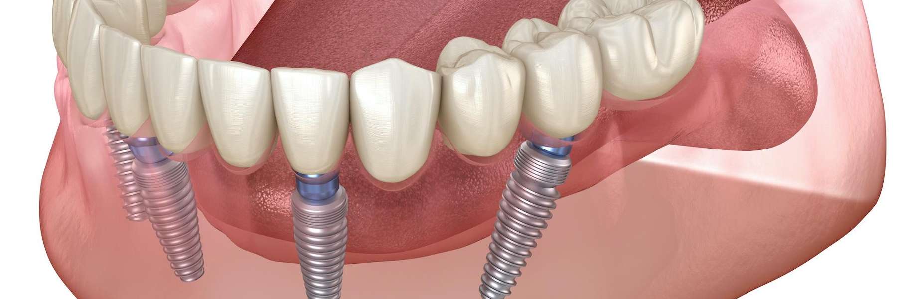 Image of all on four dental implants, charlotte nc