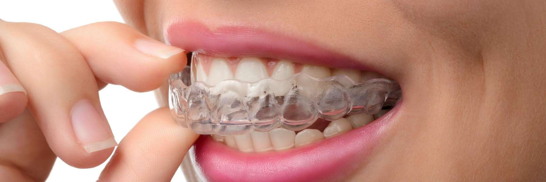 A woman putting in her Invisalign trays