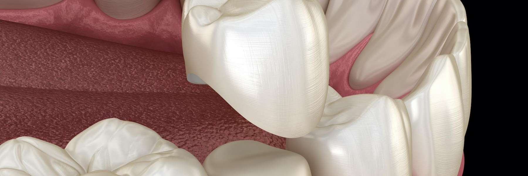 How Much Do Dental Crowns Cost? Charlotte, NC Gentry Dental