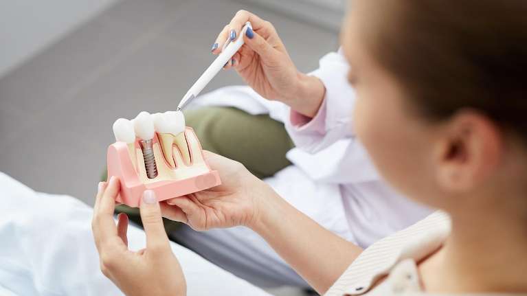 Dental Implants DIagram | Charlotte NC Dentist