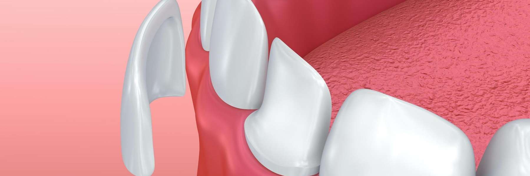 Diagram of veneers in Charlotte NC