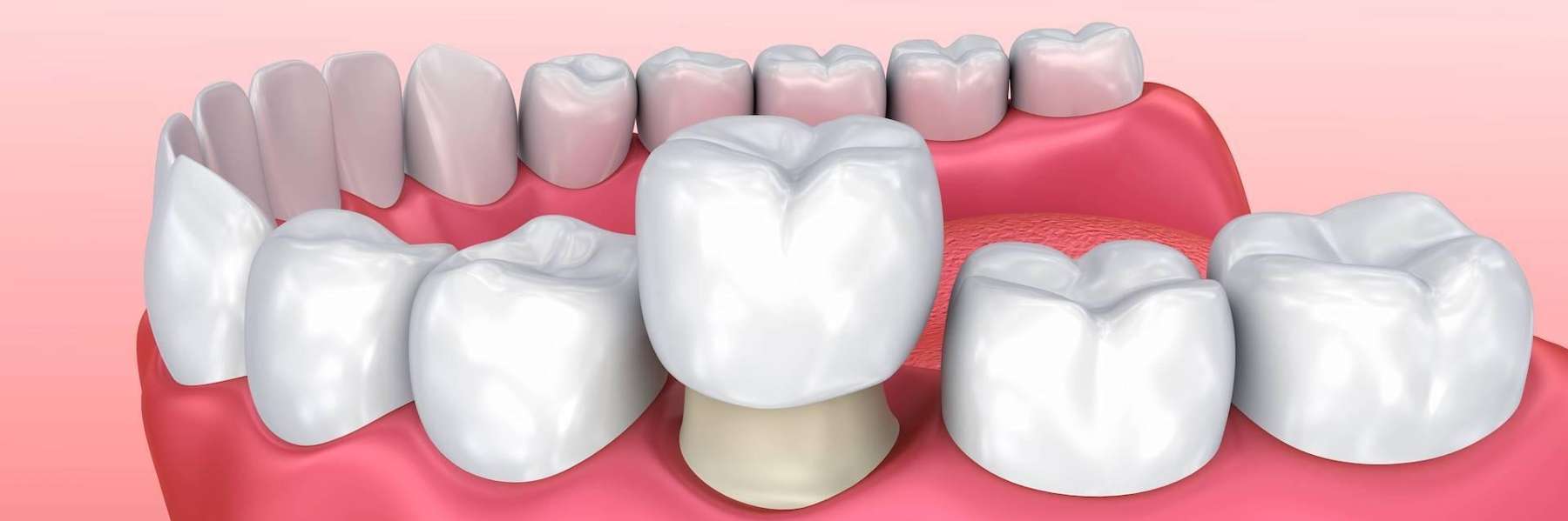 Dental crown being put on a tooth, charlotte nc