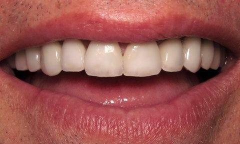 Porcelain Veneers After Image | Charlotte NC Dentist