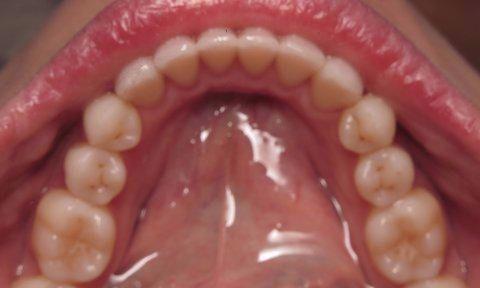Invisalign Before & After Pics | Charlotte NC 