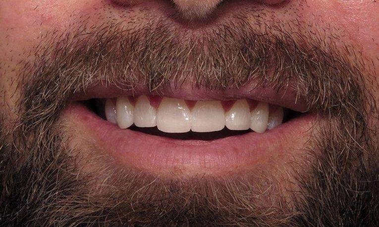 Dental Veneers Before & After Image | Charlotte NC Dentist