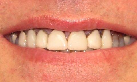 Dated Veneers Before Image | Charlotte NC Dentist
