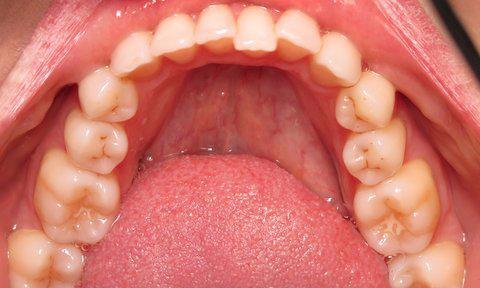 Invisalign Before Image | Charlotte NC 