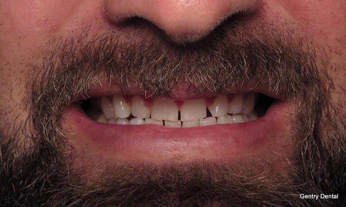 Dental Veneers Before Image | Charlotte NC Dentist