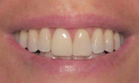 Natural-Dental-Implant-and-Crown-Placement-in-Charlotte-NC-After-Image