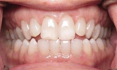 KöR Teeth Whitening after image | southpark NC