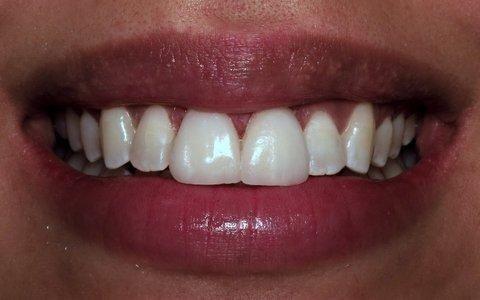 Beautiful-Dental-Veneers-in-Charlotte-NC-After-Image