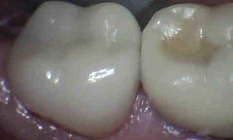 Dental Crown After Image | Charlotte NC Dentist