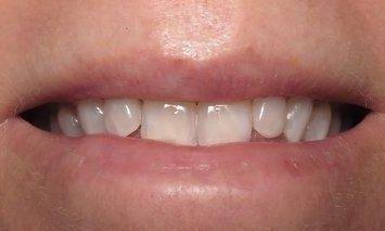 Teeth Whitening After Image | Charlotte NC Dentist