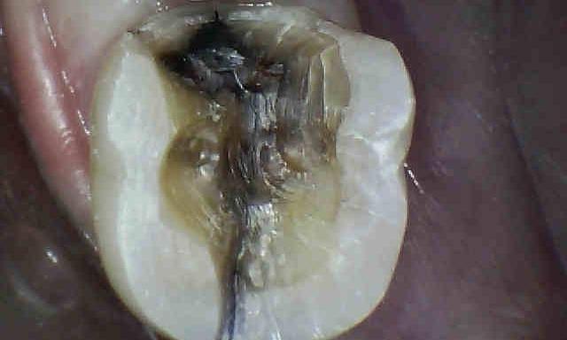 Cracks Around Old Silver Filling | Charlotte NC Dentist