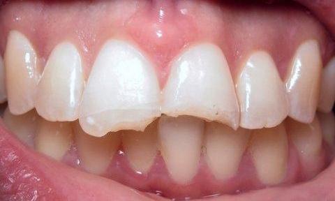Beautiful-Dental-Veneers-in-Charlotte-NC-Before-Image