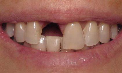 Natural-Dental-Implant-and-Crown-Placement-in-Charlotte-NC-Before-Image