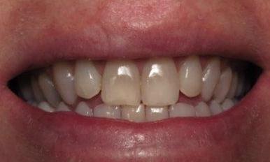 Teeth Whitening Before Image | Charlotte NC Dentist