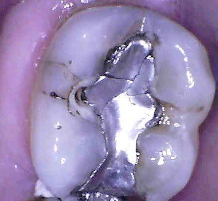 Porcelain-Dental-Crown-Restoration-in-Charlotte-NC-Before-Image