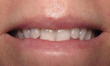 before professional whitening | southpark NC dentist
